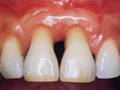 Paradontoza w skrajnej postaci może prowadzić do wypadania zębów (fot. damdent/Wikimedia)